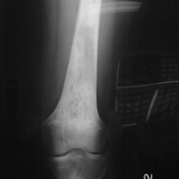 12A)Plain Radiograph Of Epithelioid Hemangioendothelioma Of Femu