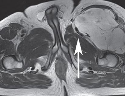 Quadriceps Mri