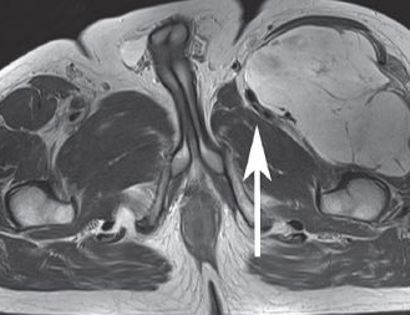 MRI of quadriceps tumor 