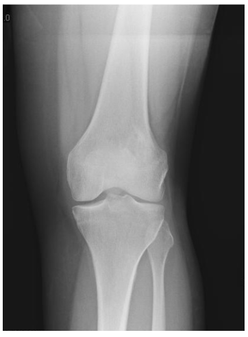 Intraosseous Osteosarcoma Xr